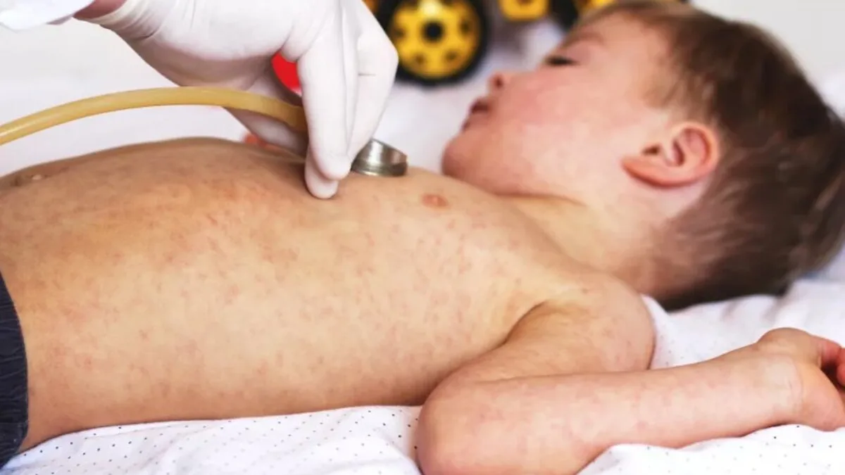 Measles outbreak in a child