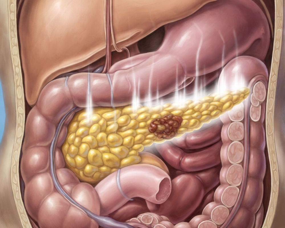 Pancreatic Cancer