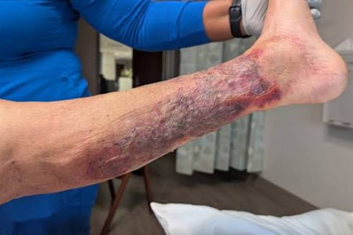 Flesh-Eating Bacteria: Louisiana Issues Urgent Warning Over Rising Infections 1 A man suffering from the flesh-eating bacteria Vibrio vulnificus